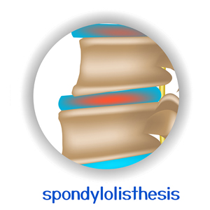 picture of Groton spondylolisthesis